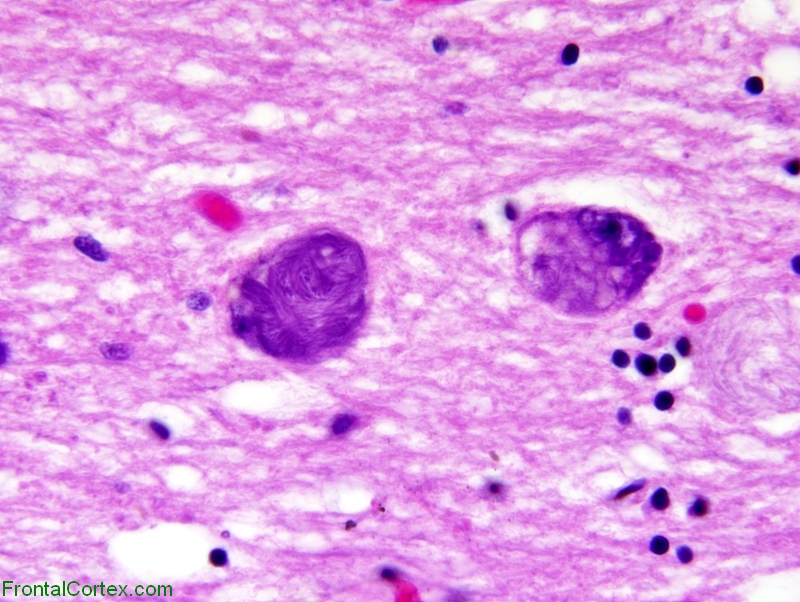 Alzheimer Disease, nucleus basalis of Meynert, H&E stain time 600